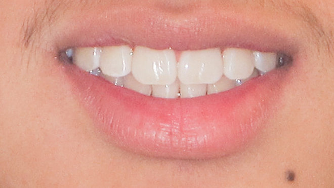 Laser Treatment for Gingival Tissue