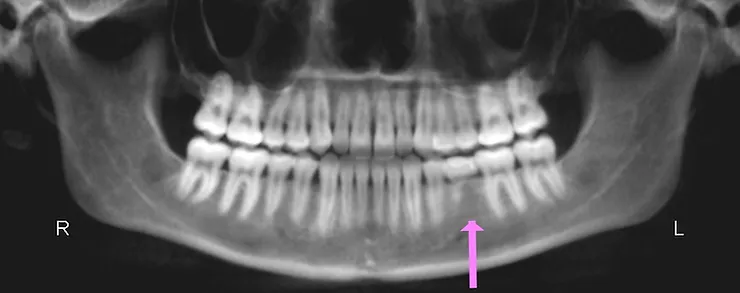 Missing Teeth? Extra Teeth?