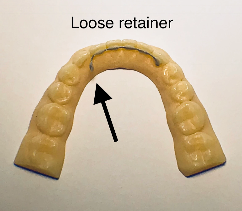 Loose Permanent Retainer