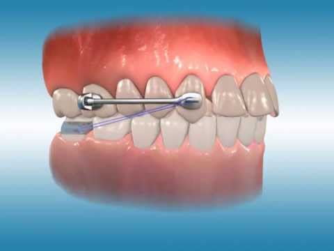 Carriere Motion Class II Appliance